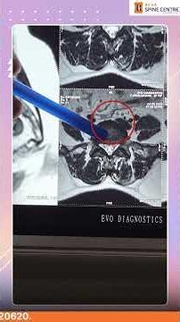 **📢 Disc Problem Without Back Pain? Do You Really Need an MRI?** #spinehealth