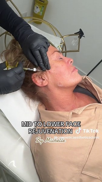 Facial Volume Restoration with Dermal Fillers