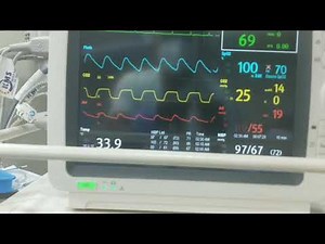 Aortic aneurysm surgery | Hemodynamic changes | Aortic cross clamp release in 2X speed