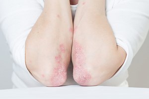 Psoriasis : plaques, squames, causes, que faire ?