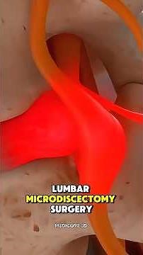 How Lumbar Microdiscectomy Surgery is Performed? (3D Animation) #3dmedicalanimation #education