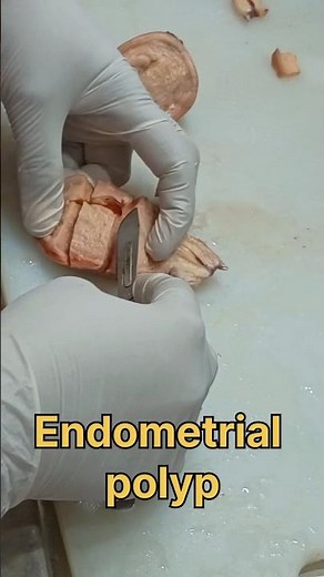 Endometrial polyp tissue processing🧐👀🤔| #tissuefixation #histopathology #urogynecology #endometrium
