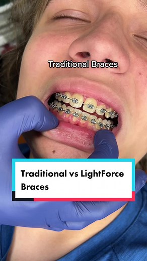 Differences Between Traditional and LightForce Braces