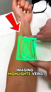 Revolutionary Vein-Imaging Tech Doctors Trust The VeinViewer uses advanced near-infrared (NIR) imaging to display veins up to 10 mm beneath the skin with remarkable clarity. This precision technology helps clinicians locate veins faster, reduce needle sticks, and improve patient comfort—making it a powerful tool in modern healthcare and medical diagnostics. credits : @ christiemedical / IG #MedicalTechnology #HealthcareInnovation #PatientCare #technology #tech | Tech Reels