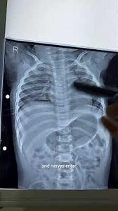 Chest x ray interpretation.