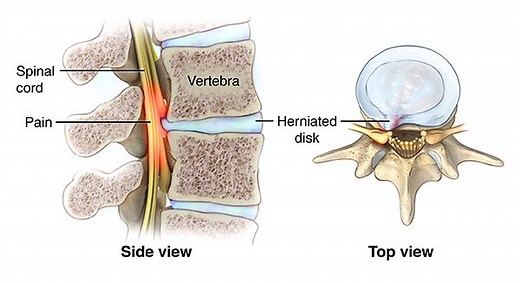 Spinal Cord Compression vs. Spinal Cord Abutment - The Chiropractor Brief for Accident & Injury Cases - Vancouver, WA - Vancouver Disc Center