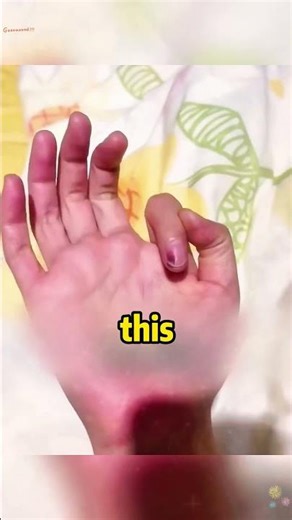 Strange Hand Disease 😨