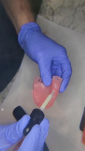 Dr. Darren Webber - Webber Comprehensive Dentistry on Instagram: "Precision matters ✨ After digitally designing this denture setup in Exocad, I printed the teeth and gingiva separately on the Form 4 to get the perfect fit and esthetics. Now comes one of the most important steps: bonding the 3D printed teeth and gingiva together with tooth-colored resin. Holding everything tight during curing ensures flawless adaptation, seamless margins, and long-lasting durability — a small detail that makes a 