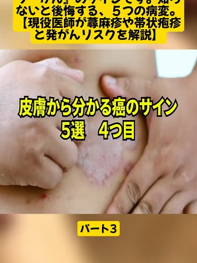 皮膚のブツブツに潜むがんのサインとは？