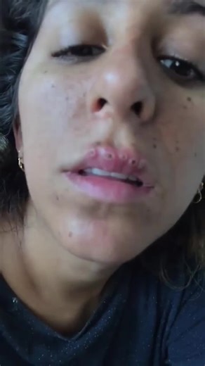 American Woman's Lip Gloss Addiction Turns Nightmarish