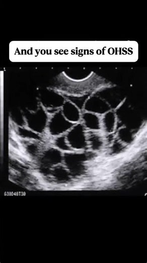 Let’s talk about OHSS, because it’s real and it’s rough 😵‍💫 Ovarian Hyperstimulation Syndrome can