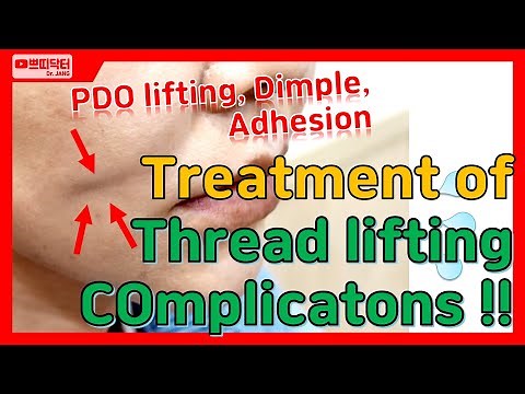 Treatment of Cog thread lifting complications. - skin dimpling and adhesions live surgery video