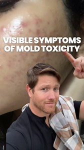 READ THE CAPTION!⬇️🏡 🍄 Fungal Acne: Mold exposure can increase the fungal population on the skin because molds are a type of fungus. This overgrowth can lead to fungal acne, which presents as small, itchy pustules on the skin. 🏥 Swollen Lymph Nodes: The immune system reacts to mold by trying to fight off the perceived invasion, which can cause lymph nodes to swell as they produce more white blood cells. 🌿 Frequent Sinus Infections: Molds release spores that can be inhaled and lodge in the na