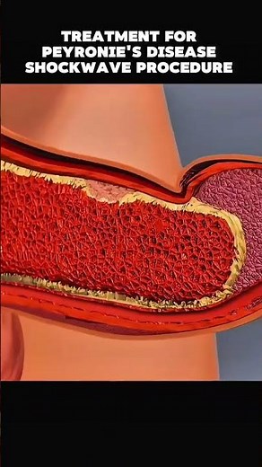 treatment for Peyronie's disease shockwave procedure 3d animation, #PeyroniesDisease #PeyroniesAw...