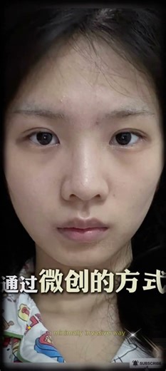 eyebrow pressure, drooping eyebrows, triangular eyes—no need for double eyelid surgery