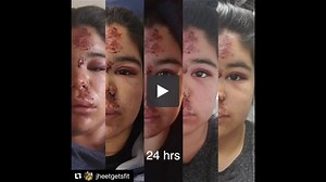 Accelerated healing with E  Therapy