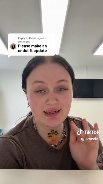 Endolift Update: What Do You Think?