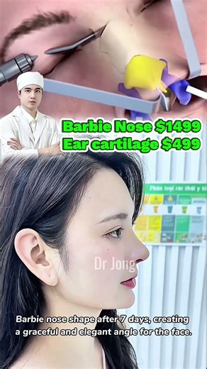 Barbie nose after 7 days. #Rhinoplasty #nose #australia #drjong