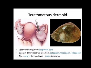 Dermoid cyst