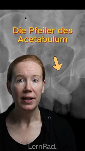 Acetabulum intakt oder Fraktur? Check diese 2 Linien #röntgen