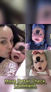 This baby girl was trolled for her looks — now at 2 years old, she is 'gorgeous' after her parents' made a brave decision. Check out little Vienna's stunning new look in the comments below👇 | Talita & Gustavo