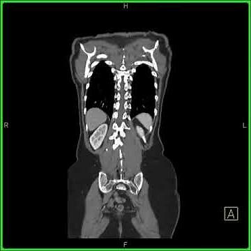 Miscellaneous:Whole body study:Whole body CT scan view as interactive display in the coronal plane.