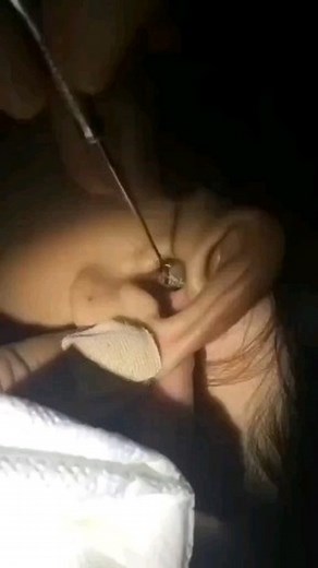 Big Pimple Videos on Instagram: "Follow us ?? @cyst.removal.videos for more pimple popping videos?? #pores #acne #skincare #blackheads #pimples #whiteheads #pimple #blackhead #skin #beauty #blackheadextraction #blackheadremoval #pimplepopping #whitehead #pimplepop #pimplepoppers"