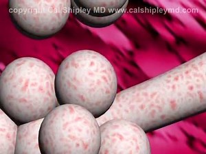 Tuberculosis review - animation and narration by Dr. Cal Shipley, M.D.