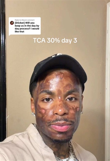 Replying to @Ahjua day three of doing a TCA 30 chemical pill. Skin is feeling tighter. Heavily applying healing topical to my face And spf 50. I’ll keep yall updated on the peeling process. #chemicalpeel #aesthetics #skincare #lifestyle