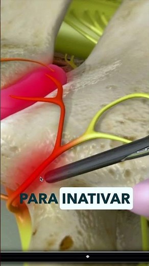 Rizotomia Cervical: Como que é feito e para que serve esse procedimento? #shorts