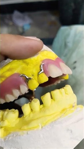 Upper Removable Cost Partial Denture Ready for Flasking 😁😁😁#rpddentalprocedure #viralshort