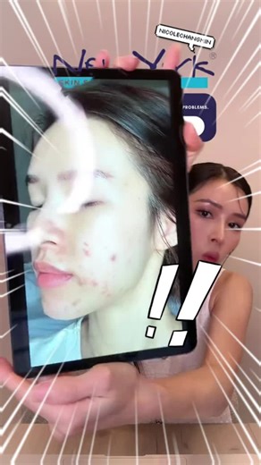 Stubborn cystic acne is sooo hard to get rid of! Here's how we helped Nicole soothe her sensitive skin and clear up those pesky pimples 🥰 #NewYorkSkinSolutions #NewYorkSkinSolutionsSG #cysticacne #acnefacial #skincaretreatment #facials #clearskin