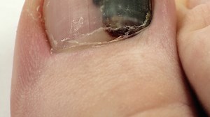 Trauma Of Toenail Subungual Hematoma Bruise Stock Footage SBV-305663855 - Storyblocks