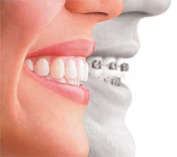 Invisalign for Adults | Clear Aligners for a Confident, Straight Smile