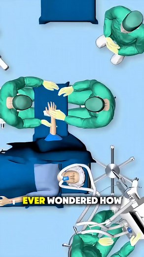 “How Four-Corner Fusion Surgery Helps Restore Wrist Function” Four-corner fusion is a complex wrist surgery performed to relieve pain from arthritis or bone collapse. Surgeons remove the scaphoid and fuse four wrist bones — the lunate, triquetrum, capitate, and hamate — with screws or plates. This technique reduces pain while preserving about half of the wrist’s motion. 👩‍⚕️ Watch the step-by-step surgical process and learn how this life-changing operation works! #OrthopedicSurgery #WristFusion