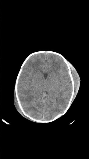Subgaleal hematoma #ctbrain