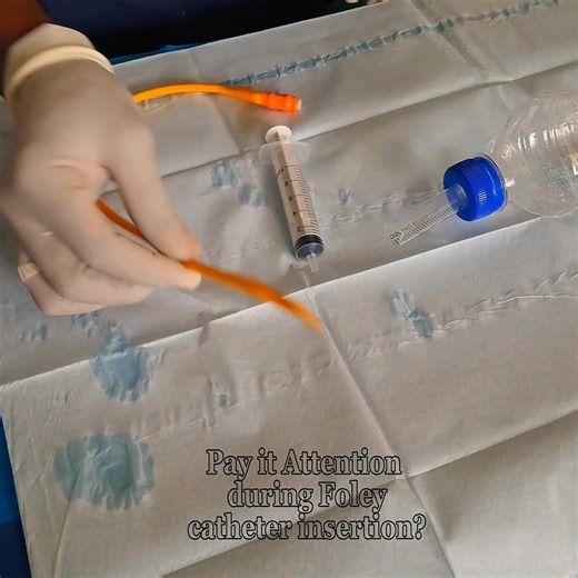 Urethral trauma from a Foley catheter insertion #creatorsearchinsights #ethiopian_tik_tok🇪🇹🇪🇹🇪🇹🇪🇹ሀገሬ #oromotiktok❤️💚❤️ethiopiantiktok #viraltiktokvideos✅ @ዶ/ር ዐብይ ታደሰ (ENT&HN surgeon) @Titi Sisay @Dr Dhabessa @ዶ/ር መክብብ ቸሬ (Urologist) @@adi!! @Dr Wengelawit(Ophthalmologist)