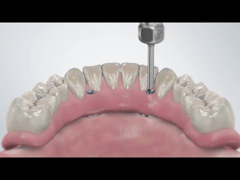 iSy® Multi-unit System