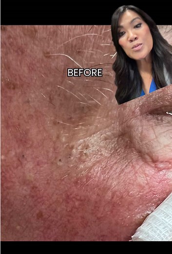 Who like Favre-Racouchot aka solar comedones? This is a professional, medical procedure performed by a licensed, board-certified dermatologist. Attempting this at home can lead to infection, scarring or worsening of the condition.