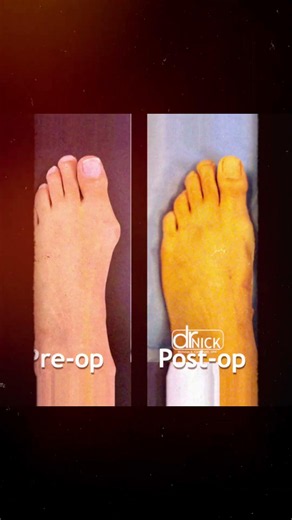 Minimally Invasive Bunion Surgery
