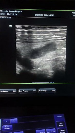 acute appendicitis seen in ultrasound #ultrasound #