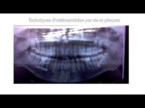 Bases anatomique du traitement des fractures mandibulaires