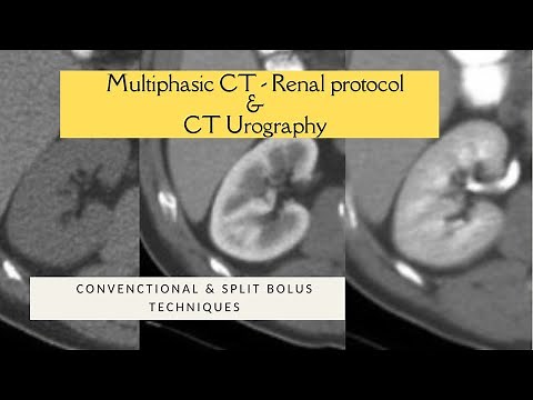 MULTIPHASIC RENAL CECT PROTOCOL + SPLIT BOLUS TECHNIQUE. CT UROGRAPHY. Triple bolus technique
