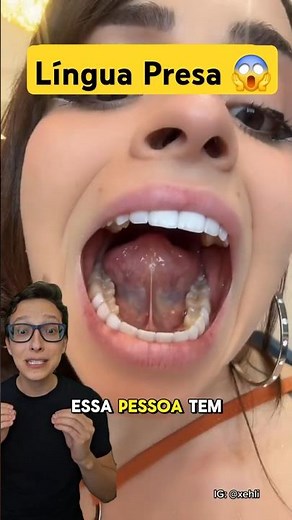 Língua Presa 😱 #medicina #medico #enfermagem #fonoaudiólogo Freio da Língua Frenectomia Frenotomia