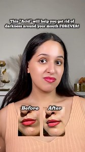 Drishti Vohra on Instagram: "Comment “Acid” to get the link directly in your dms🫶🏻 Darkness around mouth is a lot of people’s insecurity but a proper skincare will definitely improve it and this is not some random acid but an acid for the skin! Sounds scary right? But It’s very helpful in improving pigmentation and safe to use! So quickly comment for the link but before that FOLLOW @recreatewithdrish for more such skincare tips✨ Causes of darkness around mouth👇🏻 1