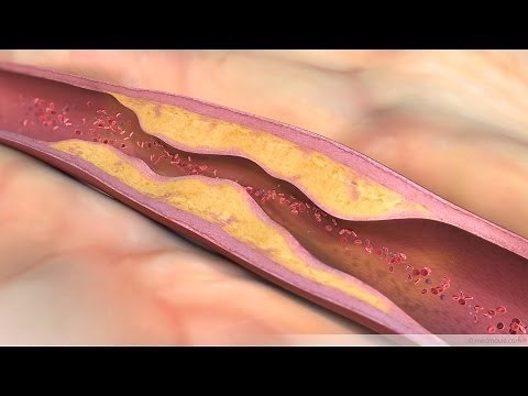 What is Atherosclerosis?