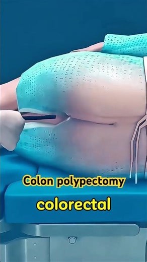 Colon Polypectomy #polypectomy #shorts