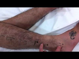 Acupuncture, Gall Bladder Channel, Part II