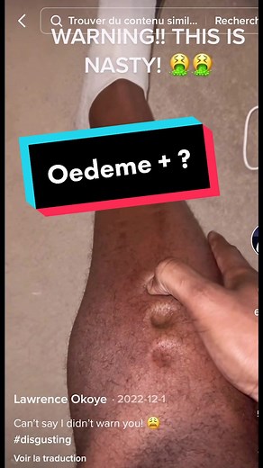 J'ai vraiment simplifié dans la vidéo ! Ya beaucoup de causes possibles, même les varices peuvent causer des œdèmes mais c'est plutôt léger. En cas d'apparition rapide ou inhabituelle ou unilatérale d'oedemes : Consultez votre médecin pour qu'on trouve la cause ! #pourtoi #storytime #sante #medical #medecin #urgence #chirurgie #incroyable #pov #phlebite #hopital #coeur #urgence #prevention #infirmiere #samu #emboliepulmonaire #risque #foie #cirrhose #viral #viralvideo