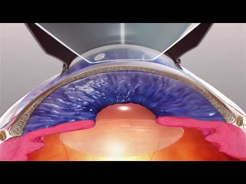 Ellex Selective Laser Trabeculoplasty (SLT) Animation - Patients